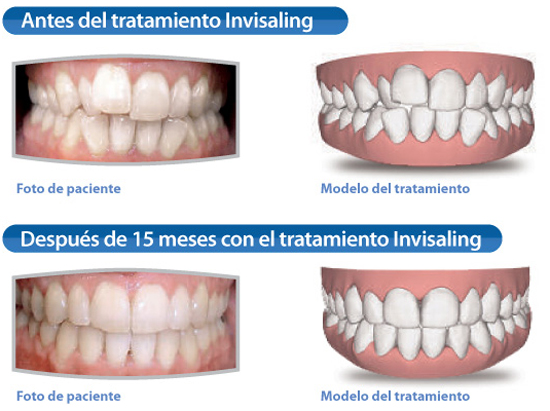 invisalign